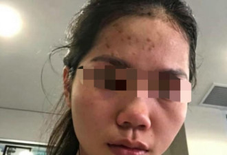 “滚回你的国家”越南留学生戴口罩遭辱骂