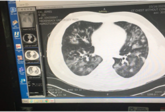 美国华裔确诊者蔡敏出院 肺部感染照片首曝光