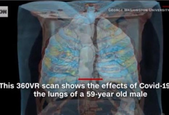 美发布3D视频360度呈现新冠患者肺部损伤