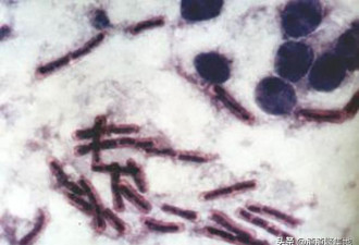 东非出现神秘X病毒, 症状与埃博拉相似