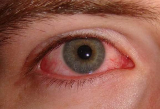 新冠病毒可眼内存活数周 眼睛发红或为前兆