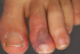 皮肤病专家：如果手脚红肿发紫，您可能感染了