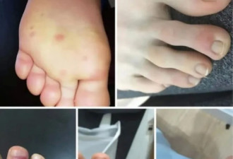 新冠恐致男女不育，脚上起痘或是无症状前兆！