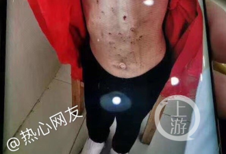 黑龙江4岁女童疑遭继母殴打致颅内出血...