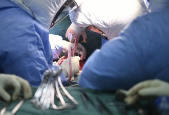 新冠患者出现后遗症 首例双肺移植手术成功实施