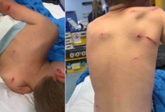 新州5岁自闭男童为保护妹妹遭袋鼠袭击！