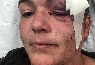 美国女记者报道中遭警方射中眼球爆裂