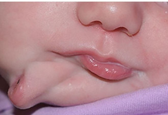 美国出现超罕见女婴 脸上有两个嘴巴