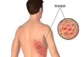 重磅！这个疫苗终于来了，7月开打