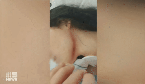 两男大打出手 劝架女孩脸部被划出10厘米口子！