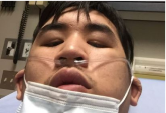 败给新冠！加国华裔小伙插管续命一个月 还失忆