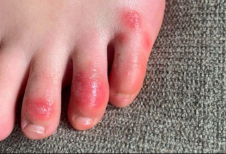 皮疹、水泡、红斑 国外多地出现“新冠脚趾”