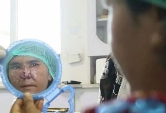 被丈夫割掉鼻子的阿富汗女孩现在还没离婚