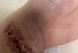 26岁韩国女偶像再度割腕，伤口曝光狰狞吓人