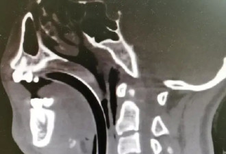 中国24岁姑娘骑电动车惨遭“割喉”