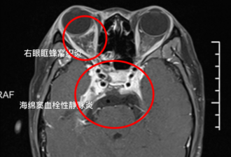 19岁女孩挤痘痘引颅内感染！我真的命大