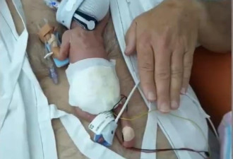 最小婴儿出生！比手掌小，克服种种疾病