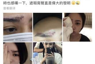 心疼！阿娇首晒受伤照，超长伤口触目惊心！