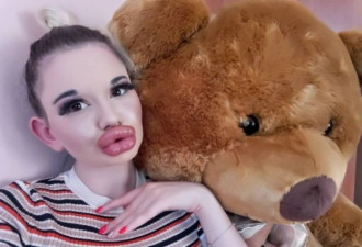 保加利亚女21次丰唇，超大腊肠嘴快碰到鼻子