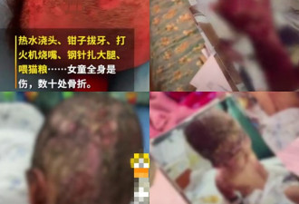 中国女童被亲妈及其姘头狂虐3个月