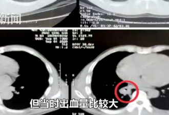 男子每天咳血15毫升 竟和20年前的一个笔头有关