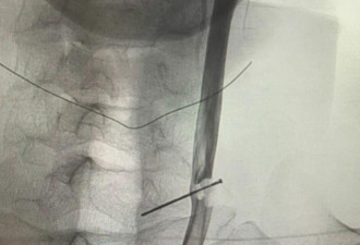 长钉穿透颈动脉十多年，男子竟毫无察觉