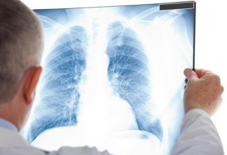 有些症状不可忽视 可能是肺癌的肺外表现
