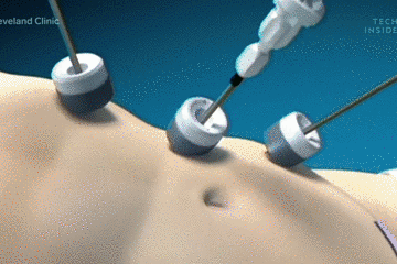 3D动画揭秘：医生手术时 对切开的身体做了什么