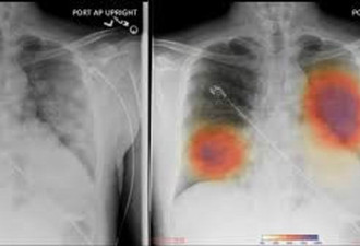 美国新冠患者肺部X光曝光 后遗症比老烟枪还惨