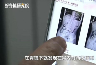 11岁男孩春节吃饺子吞2枚币 1年后取出：已腐蚀