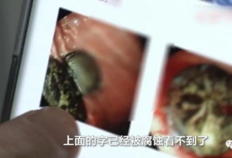 11岁男孩春节吃饺子吞2枚币 1年后取出：已腐蚀