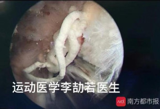 尿酸超标！25岁中国小伙膝关节里能挤“牙膏”