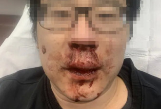 华人教师遭4人拳打脚踢 被打到满脸是血