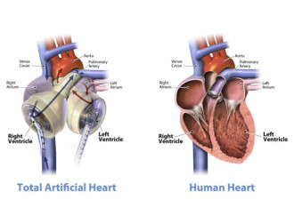 花100万买一颗人工心脏，能让你活到200岁吗？