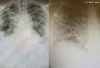 多伦多医生发X光片：被病毒侵害的肺成这样！