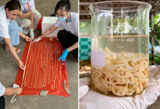 男子吃生牛肉 体内取出18米长的寄生虫