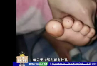爷爷针扎2岁孙子，十指放血，差点把娃害惨！