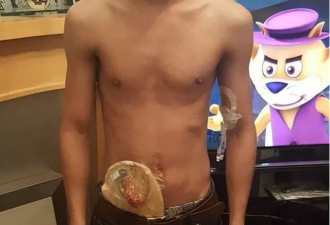 疯狂的同性生活：失去了肛门，还感染了艾滋