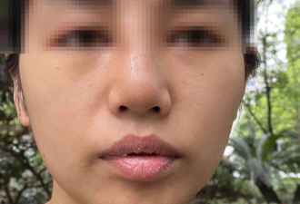 美容机构回应女子被整歪鼻子 只修复 退3000元