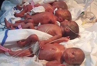 25岁妇女产下9胞胎 比产前检测到的还多两个