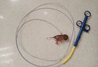 14岁男孩将活龙虾塞进肛门:想把它变成龙虾干