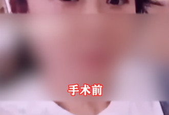 女子花2万元割双眼皮失败 老公看后要闹离婚