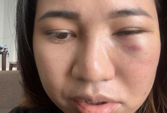 亚裔女搭地铁时突遭暴力 脸被嫌犯打肿