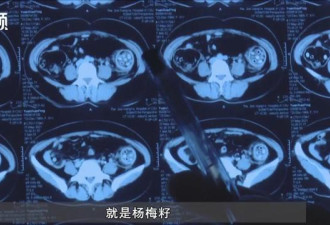 中国女子体内惊现百余颗杨梅核 医生手术时发现