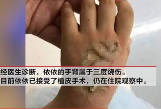 小心！电话手表突然自燃，4岁女童手背被烧伤