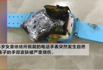 小心！电话手表突然自燃，4岁女童手背被烧伤