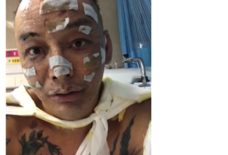 知名歌手40%皮肤烧伤，脸部毁容严重难辨认