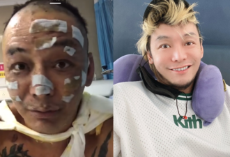知名歌手40%皮肤烧伤，脸部毁容严重难辨认