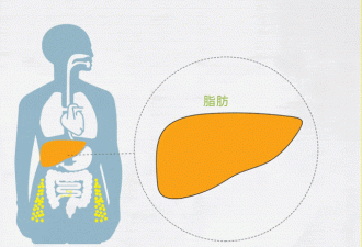 脂肪肝有多狠 它让这种癌的风险高204%