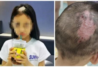 深圳多名儿童因养宠物患头癣 6岁女童玩猫秃头